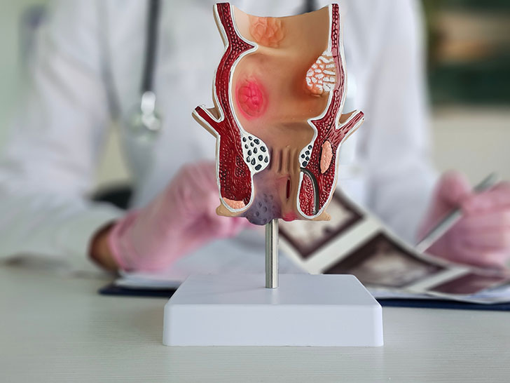 A doctor with an anatomical structure of a rectum showing haemorrhoids