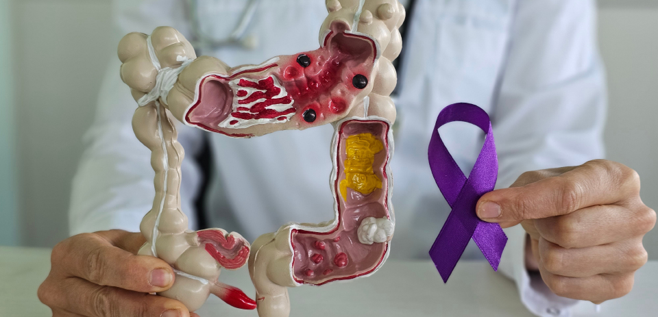 Doctor holding a colorectal model and purple awareness ribbon to illustrate colorectal cancer screening and prevention