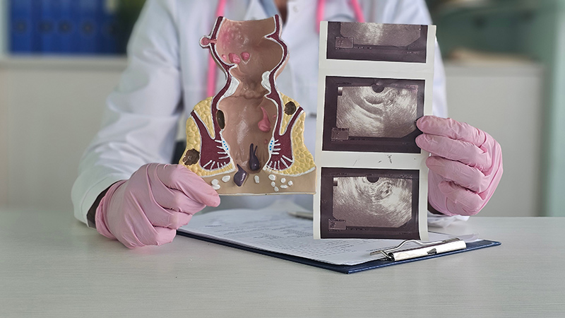 A colorectal specialist reviewing the results of an assessment with a patient