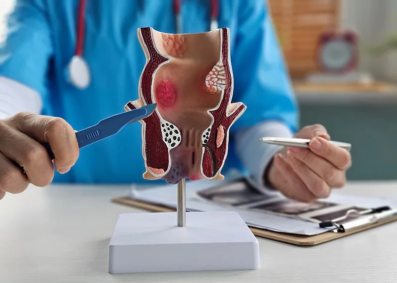 A doctor pointing to an anatomical diagram of a colon polyp