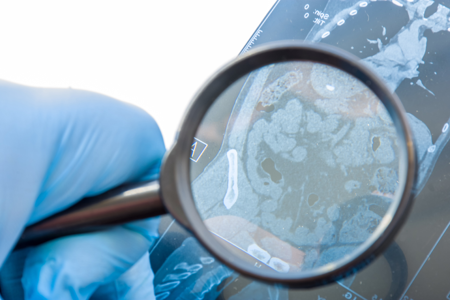 Doctor examining abdominal CT scan image to identify colorectal abnormalities during diagnostic assessment