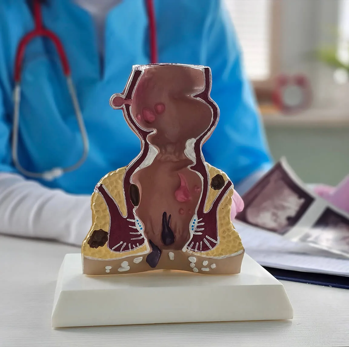 How to Choose the Right Surgeon for Haemorrhoid Treatment