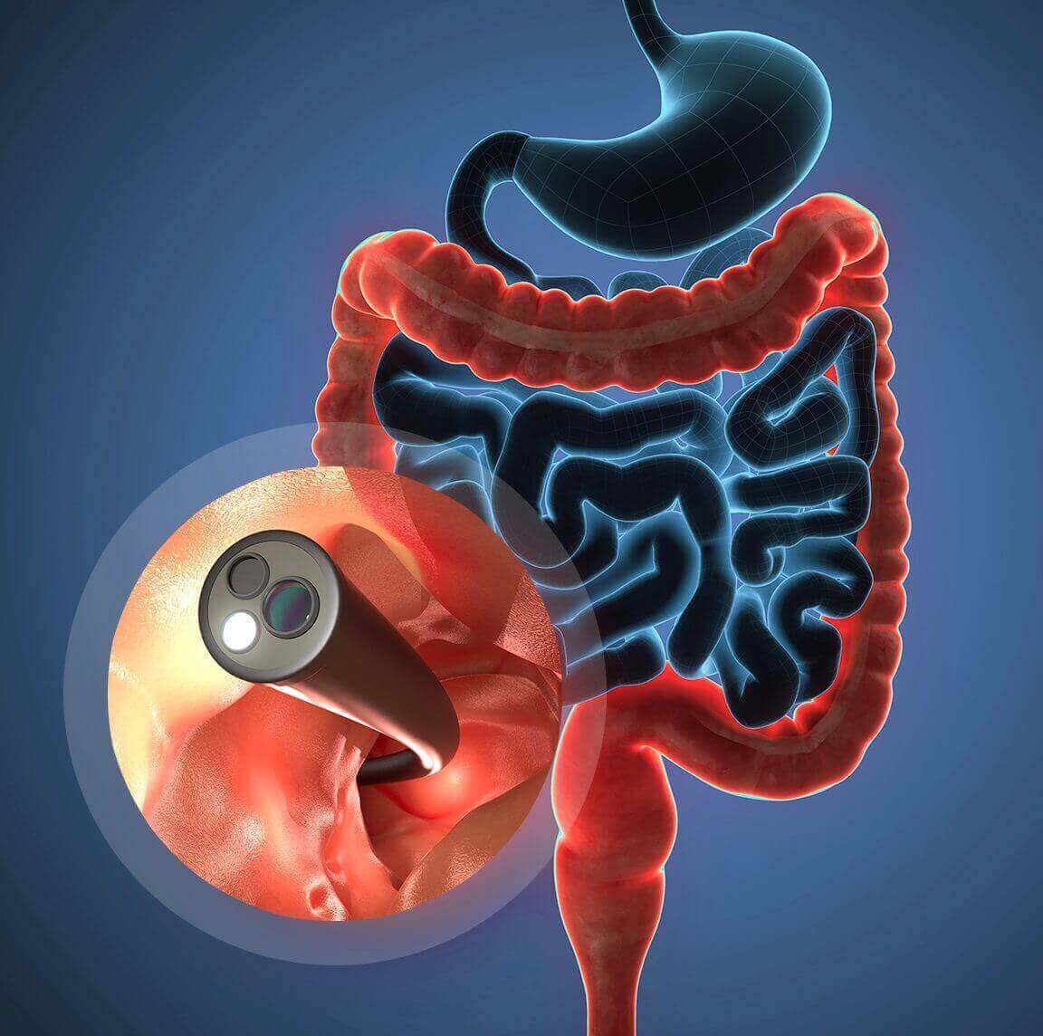 Preparing for a Colonoscopy